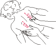 рис.1 (Прием разминания)